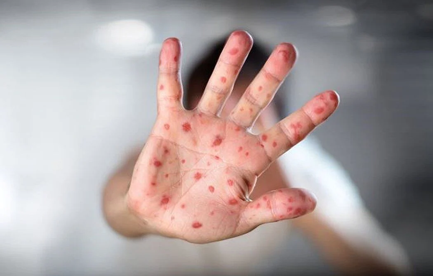Measles outbreak in Grand Erie has surpassed Ontario’s total cases for 2024